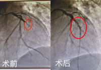 【生死時(shí)速 為生命護(hù)航】心梗患者感激送錦旗