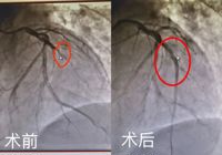 0401【生死時(shí)刻，全力以赴】武寧縣人民醫(yī)院成功搶救一名急性心肌梗死患者