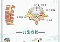 【健康科普】武寧縣人民醫(yī)院外一科：走路腰疼，雙腿乏力，您可能患有腰椎管狹窄癥