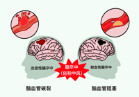 【健康科普】武寧縣人民醫(yī)院內(nèi)二科：卒中識(shí)別早，救治效果好！