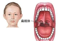 【健康科普】?jī)和馓殷w、腺樣體腫大，要手術(shù)嗎？