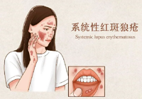 【健康科普】武寧縣總醫(yī)院人民醫(yī)院院區(qū)內(nèi)五科：帶您了解系統(tǒng)性紅斑狼瘡，不再談“狼”色變